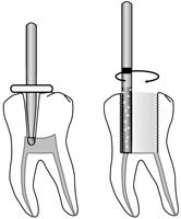 pulpout