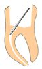 enododoncja
