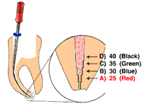 enododoncja