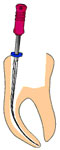 enododoncja
