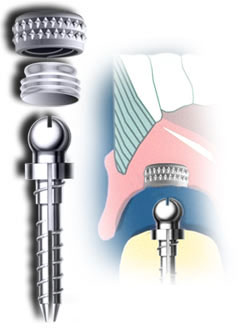 Flexi-Overdenture
